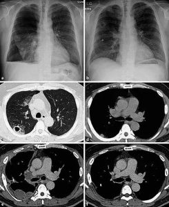 如何判断PD-1是否适合自己？4个方法教你 