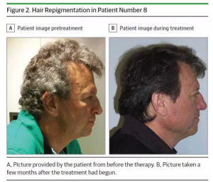 PD-1抗体居然能让癌症患者“白发”变“黑发”